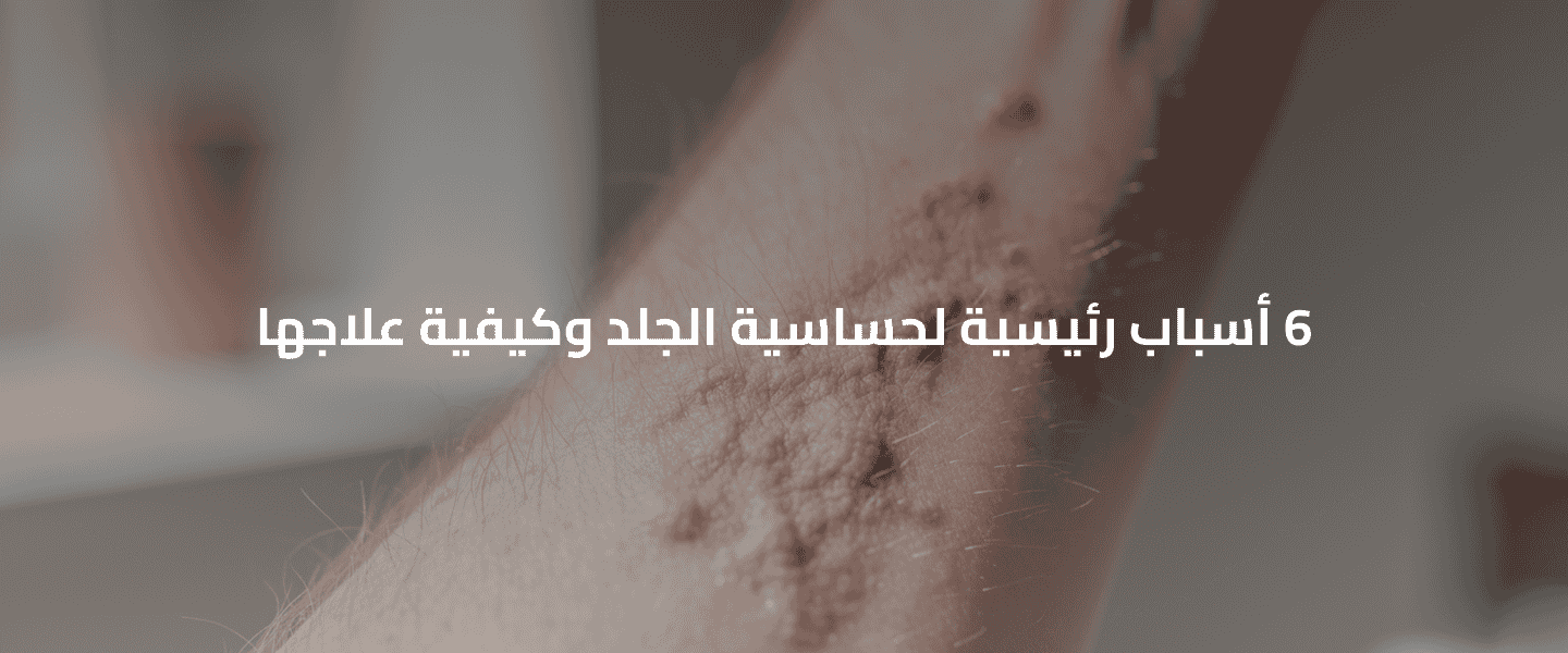 حساسية الجلد